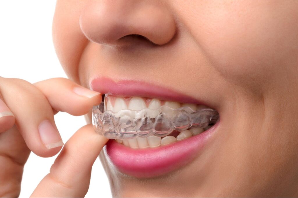 How Quickly Does Invisalign Correct Tooth Alignment