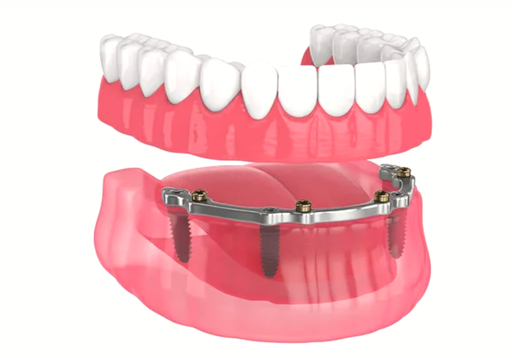 Implant retain denture, dentist in tumut